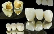 貴金屬烤瓷牙 貴金屬烤瓷牙
