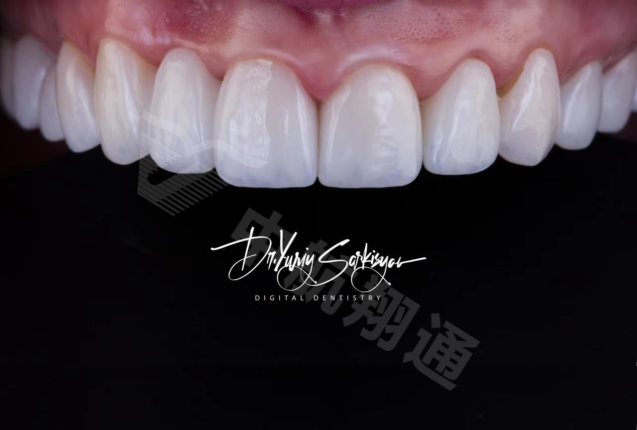 XTCERA 3D White XTCERA 3D White