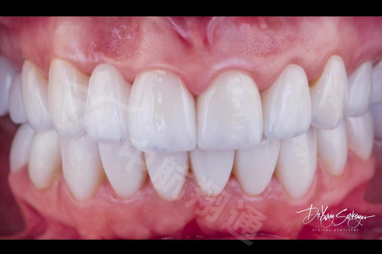 XTCERA 3D White XTCERA 3D White