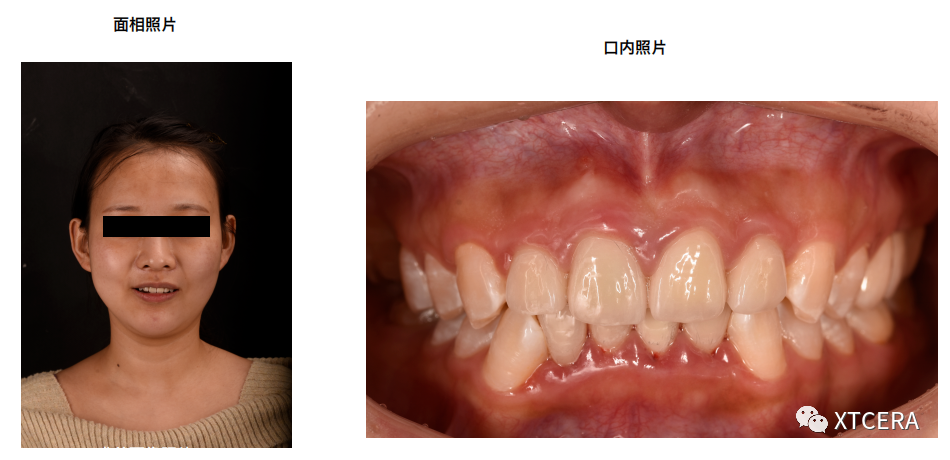 前牙區(qū)美學修復臨床病例?例|全冠修復病例分享（2）