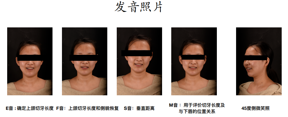 前牙區(qū)美學修復臨床病例?例|全冠修復病例分享（2）