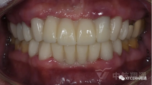 前牙?次修復(fù)氧化鋯美容冠修復(fù)病例分享 前牙?次修復(fù)氧化鋯美容冠修復(fù)病例分享