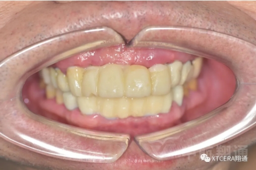 前牙?次修復(fù)氧化鋯美容冠修復(fù)病例分享 前牙?次修復(fù)氧化鋯美容冠修復(fù)病例分享