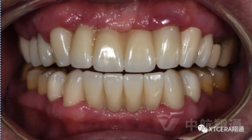 前牙?次修復(fù)氧化鋯美容冠修復(fù)病例分享 前牙?次修復(fù)氧化鋯美容冠修復(fù)病例分享