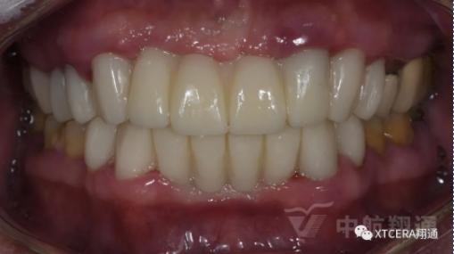 前牙?次修復(fù)氧化鋯美容冠修復(fù)病例分享 前牙?次修復(fù)氧化鋯美容冠修復(fù)病例分享