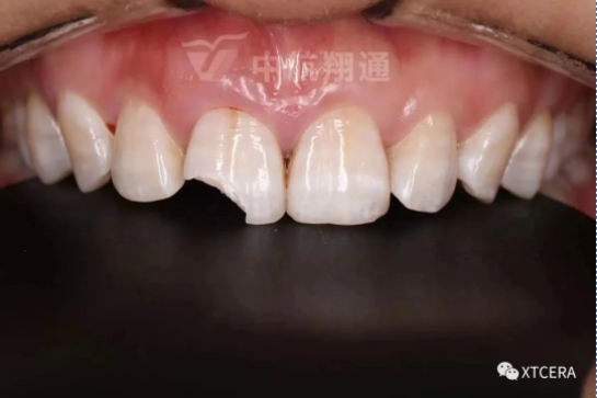 前牙區(qū)美學(xué)修復(fù)一例|全冠修復(fù)病例分享 前牙區(qū)美學(xué)修復(fù)一例|全冠修復(fù)病例分享