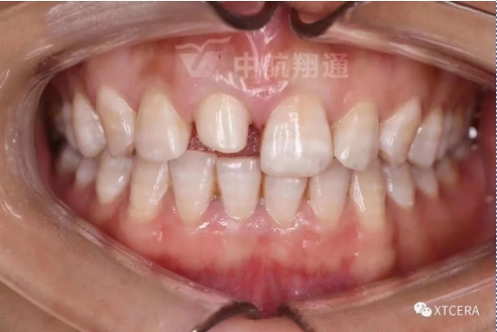 前牙區(qū)美學(xué)修復(fù)一例|全冠修復(fù)病例分享 前牙區(qū)美學(xué)修復(fù)一例|全冠修復(fù)病例分享