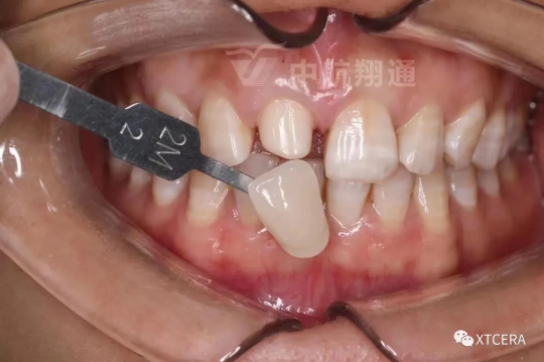 前牙區(qū)美學(xué)修復(fù)一例|全冠修復(fù)病例分享 前牙區(qū)美學(xué)修復(fù)一例|全冠修復(fù)病例分享