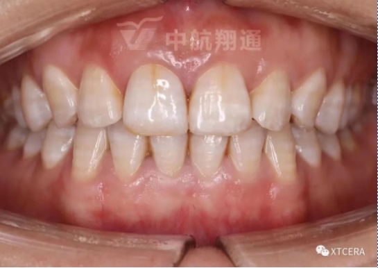 前牙區(qū)美學(xué)修復(fù)一例|全冠修復(fù)病例分享 前牙區(qū)美學(xué)修復(fù)一例|全冠修復(fù)病例分享