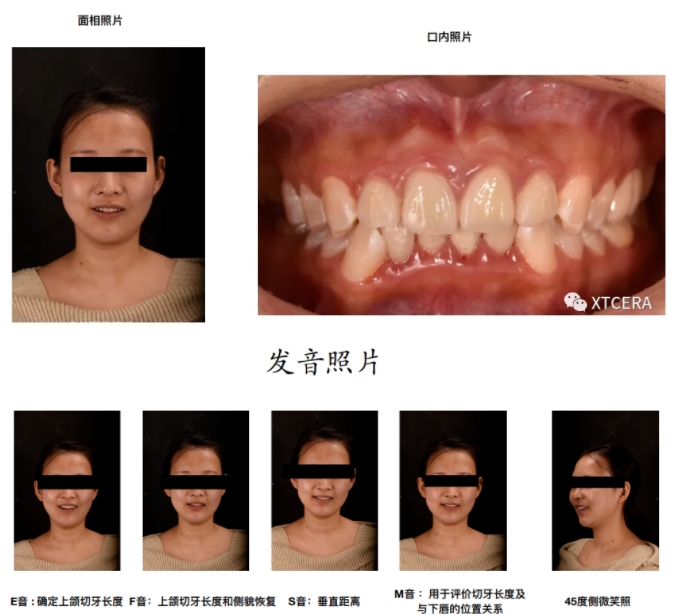 前牙區(qū)美學(xué)修復(fù)臨床病例?例|全冠修復(fù)病例分享 前牙區(qū)美學(xué)修復(fù)臨床病例?例|全冠修復(fù)病例分享