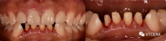 前牙區(qū)美學(xué)修復(fù)臨床病例?例|全冠修復(fù)病例分享 前牙區(qū)美學(xué)修復(fù)臨床病例?例|全冠修復(fù)病例分享