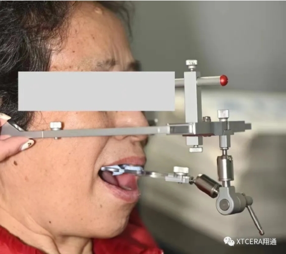 全口氧化鋯美學修復臨床病例分享 全口氧化鋯美學修復臨床病例分享