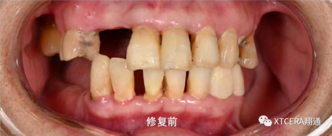 全口氧化鋯美學修復臨床病例分享 全口氧化鋯美學修復臨床病例分享