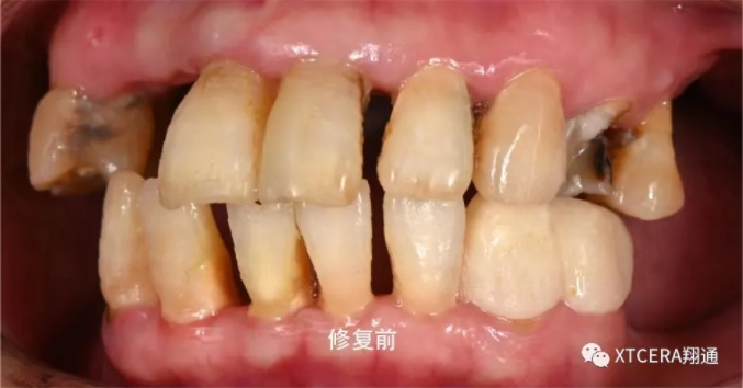 全口氧化鋯美學修復臨床病例分享 全口氧化鋯美學修復臨床病例分享