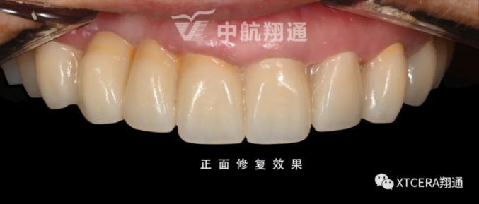 全口氧化鋯美學修復臨床病例分享 全口氧化鋯美學修復臨床病例分享