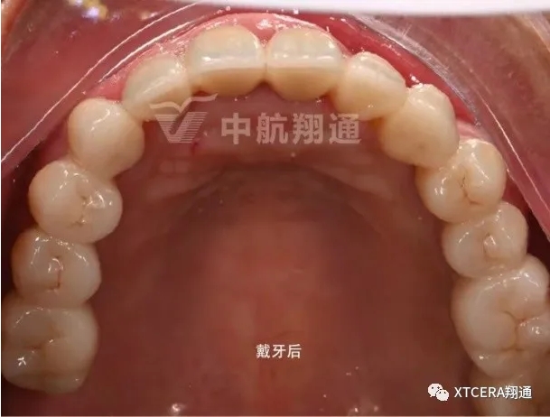 全口氧化鋯美學修復臨床病例分享 全口氧化鋯美學修復臨床病例分享