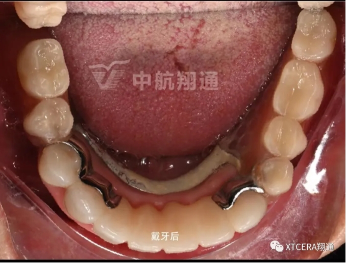 全口氧化鋯美學修復臨床病例分享 全口氧化鋯美學修復臨床病例分享
