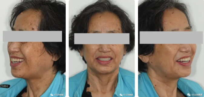 全口氧化鋯美學修復臨床病例分享 全口氧化鋯美學修復臨床病例分享
