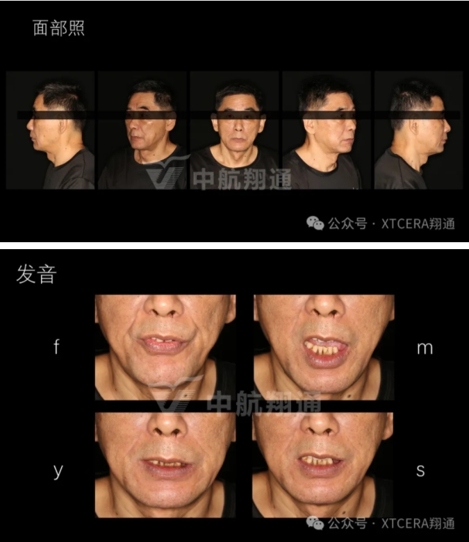 牙周病缺牙患者種植與固定修復一例 牙周病缺牙患者種植與固定修復一例