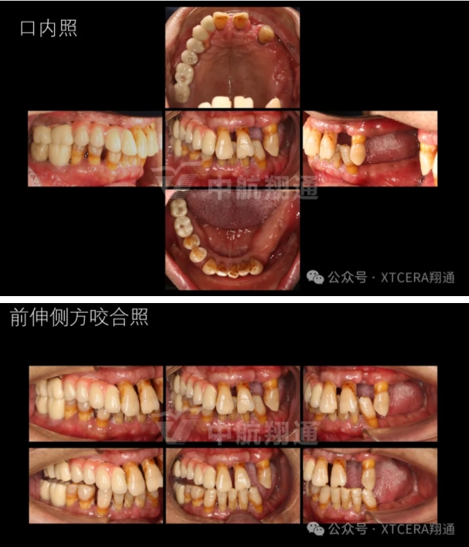 牙周病缺牙患者種植與固定修復一例 牙周病缺牙患者種植與固定修復一例