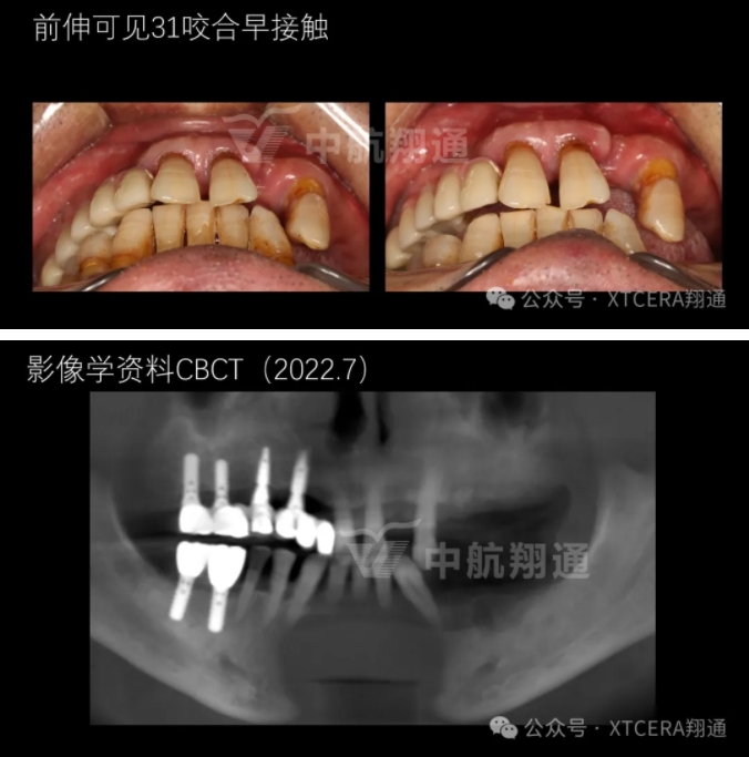 牙周病缺牙患者種植與固定修復一例 牙周病缺牙患者種植與固定修復一例
