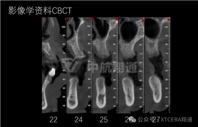 牙周病缺牙患者種植與固定修復一例 牙周病缺牙患者種植與固定修復一例