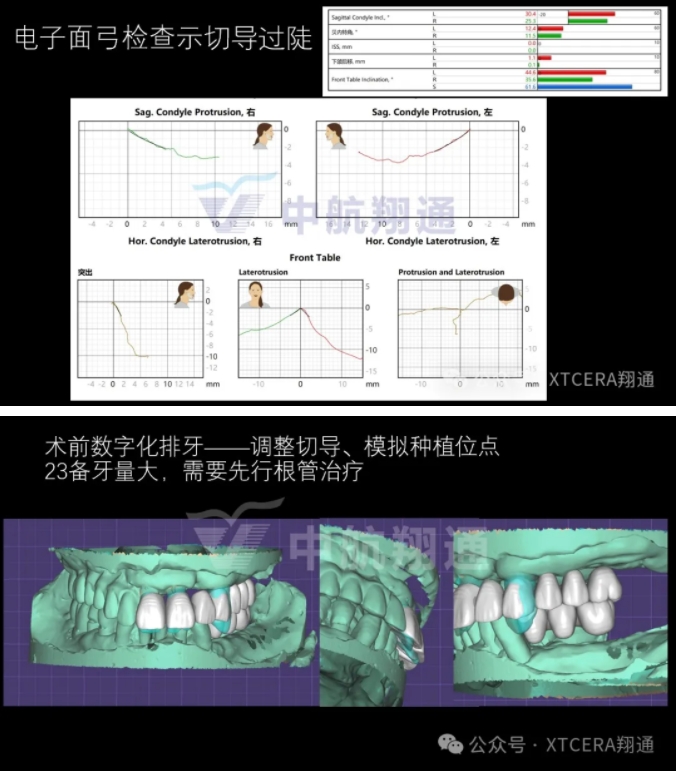 牙周病缺牙患者種植與固定修復一例 牙周病缺牙患者種植與固定修復一例