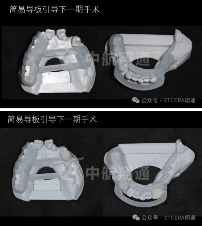 牙周病缺牙患者種植與固定修復一例 牙周病缺牙患者種植與固定修復一例
