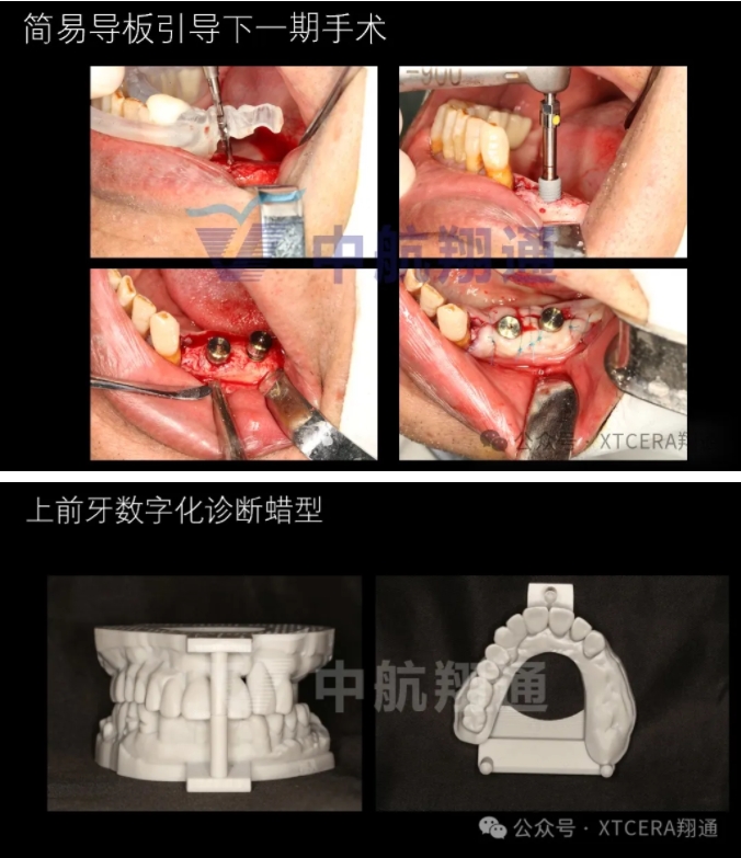 牙周病缺牙患者種植與固定修復一例 牙周病缺牙患者種植與固定修復一例