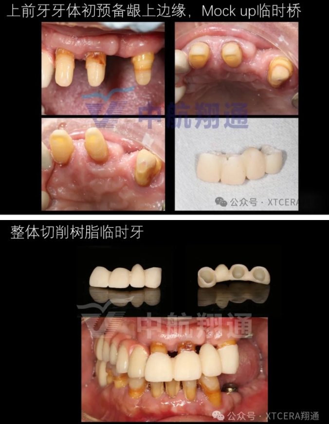 牙周病缺牙患者種植與固定修復一例 牙周病缺牙患者種植與固定修復一例