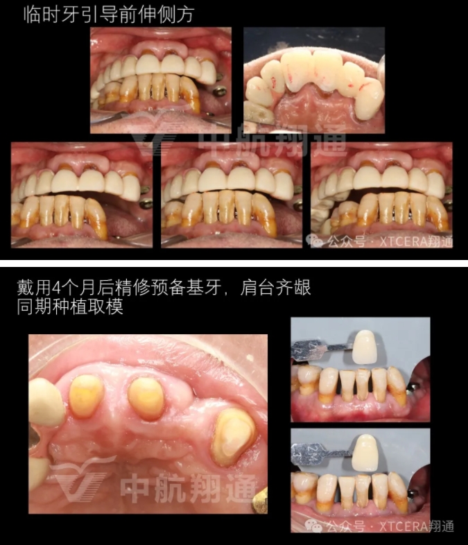 牙周病缺牙患者種植與固定修復一例 牙周病缺牙患者種植與固定修復一例