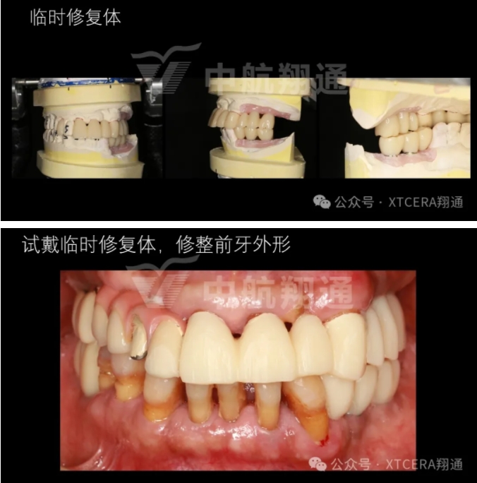 牙周病缺牙患者種植與固定修復一例 牙周病缺牙患者種植與固定修復一例