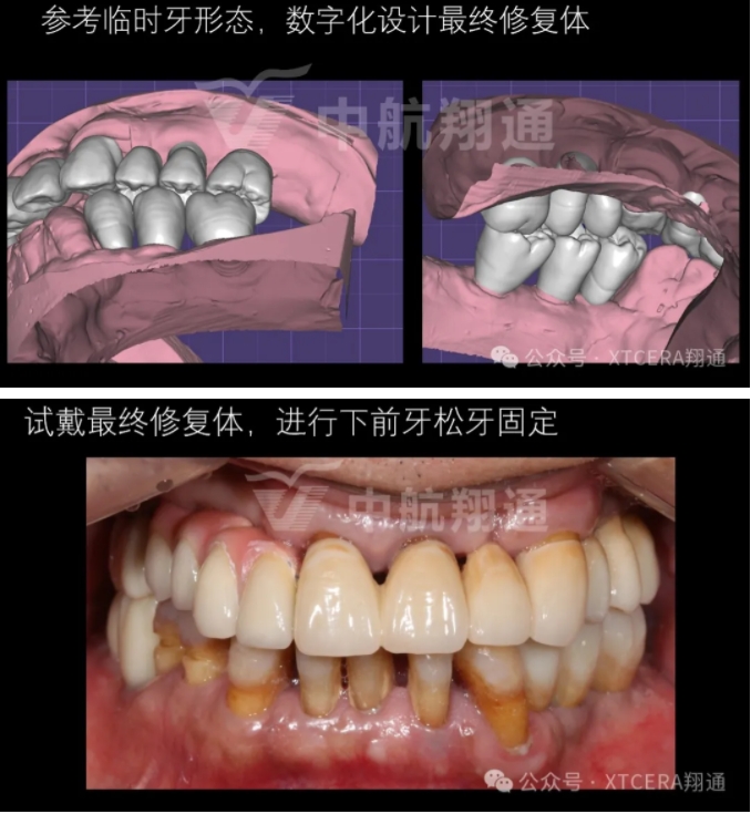 牙周病缺牙患者種植與固定修復一例 牙周病缺牙患者種植與固定修復一例