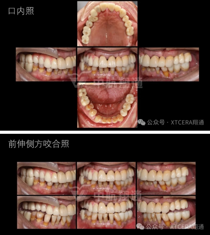 牙周病缺牙患者種植與固定修復一例 牙周病缺牙患者種植與固定修復一例