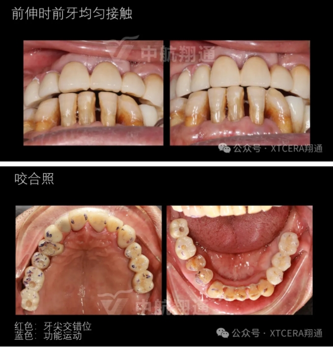 牙周病缺牙患者種植與固定修復一例 牙周病缺牙患者種植與固定修復一例