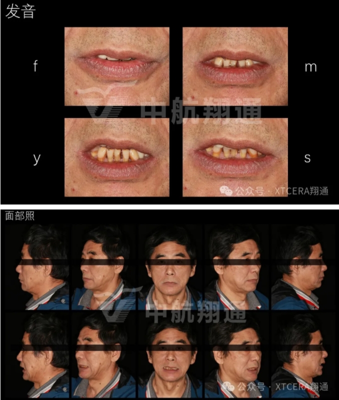 牙周病缺牙患者種植與固定修復一例 牙周病缺牙患者種植與固定修復一例