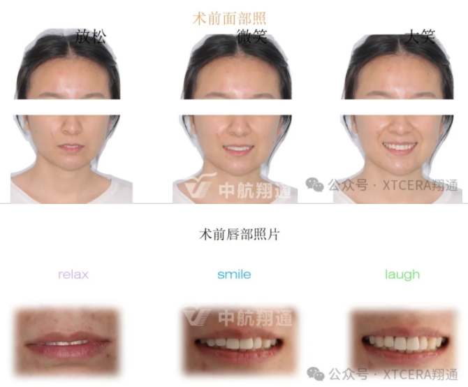 前牙再修復一例|AL-star恒星美學修復