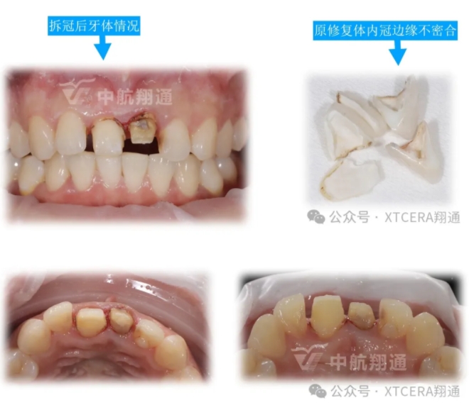 前牙再修復一例|AL-star恒星美學修復