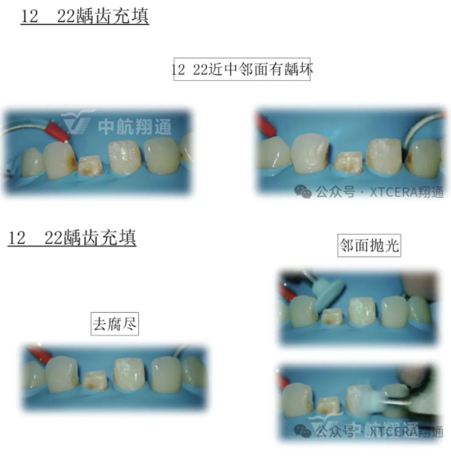 前牙再修復一例|AL-star恒星美學修復