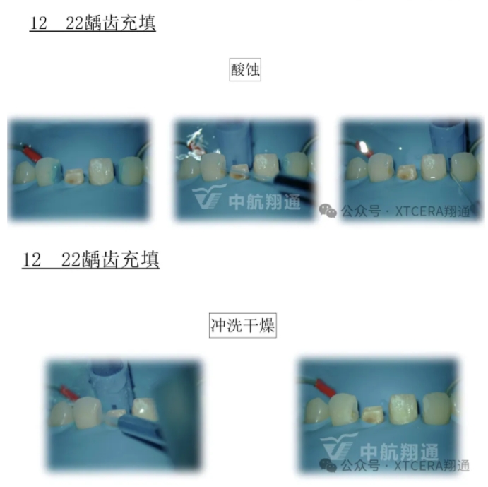 前牙再修復一例|AL-star恒星美學修復