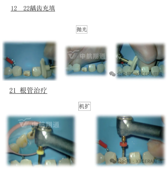 前牙再修復一例|AL-star恒星美學修復