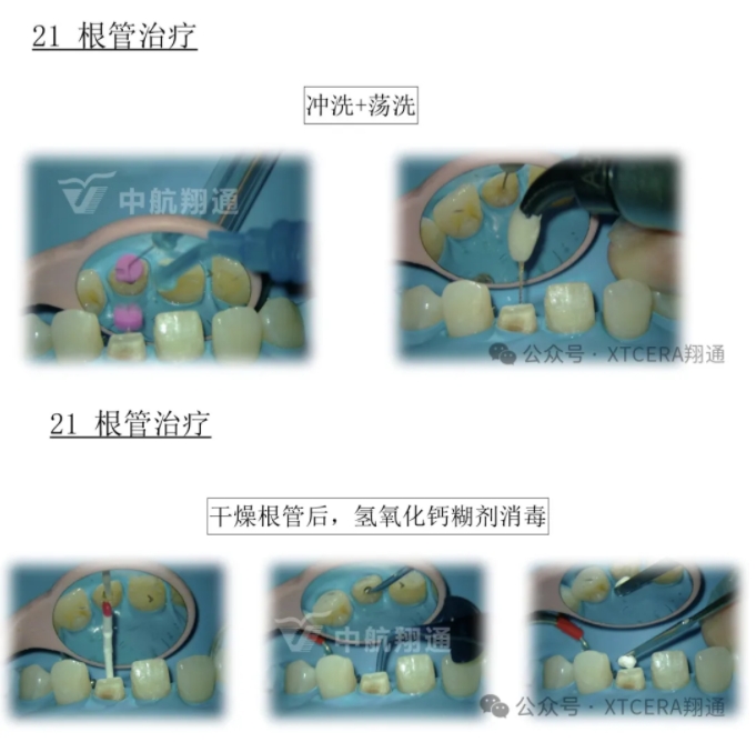 前牙再修復一例|AL-star恒星美學修復