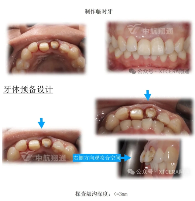 前牙再修復一例|AL-star恒星美學修復