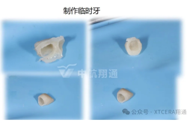 前牙再修復一例|AL-star恒星美學修復
