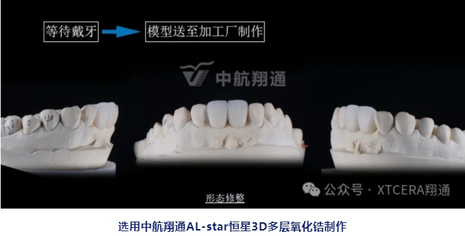 前牙再修復一例|AL-star恒星美學修復