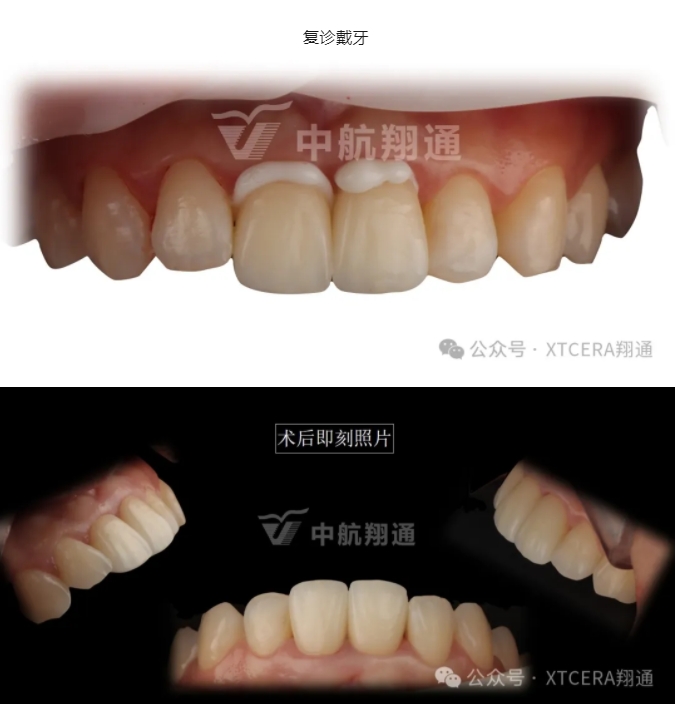 前牙再修復一例|AL-star恒星美學修復