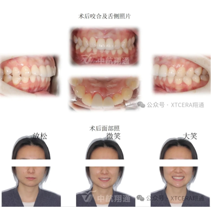 前牙再修復一例|AL-star恒星美學修復