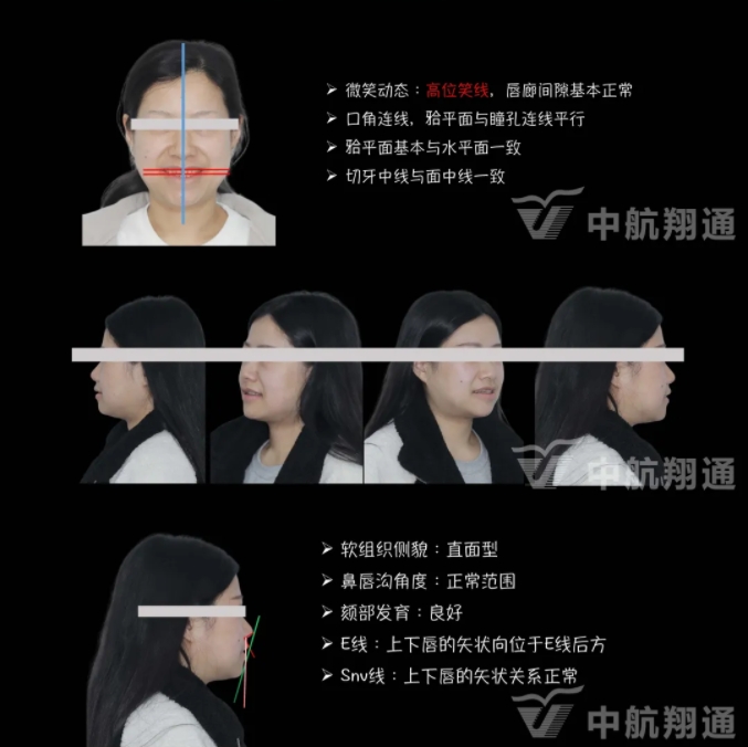 2024華人美學(xué)臨床病例大賽獲獎病例|數(shù)字化輔助牙列重度磨耗的美學(xué)和功能重建一例