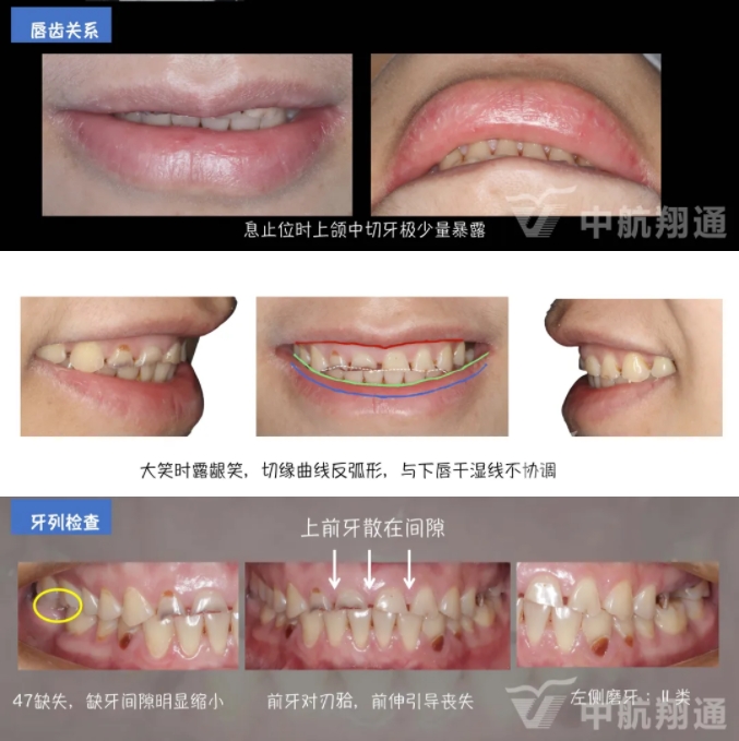 2024華人美學(xué)臨床病例大賽獲獎病例|數(shù)字化輔助牙列重度磨耗的美學(xué)和功能重建一例