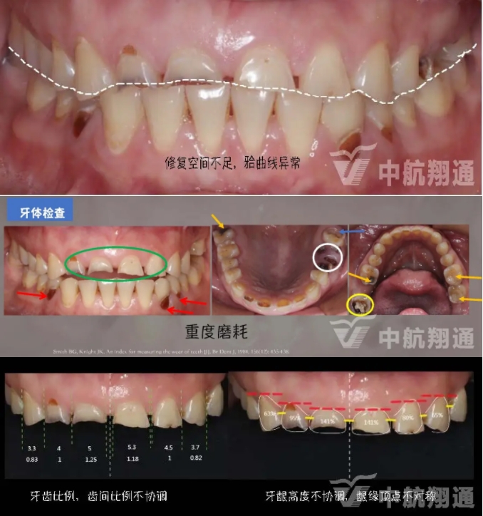 2024華人美學(xué)臨床病例大賽獲獎病例|數(shù)字化輔助牙列重度磨耗的美學(xué)和功能重建一例